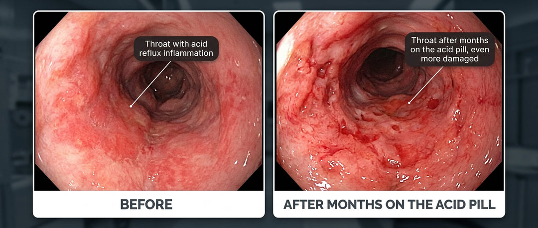 Millions get an acid pill for a throat problem that isn't acid reflux. <strong>It's silent reflux, and that pill can't reach where it burns.</strong>
